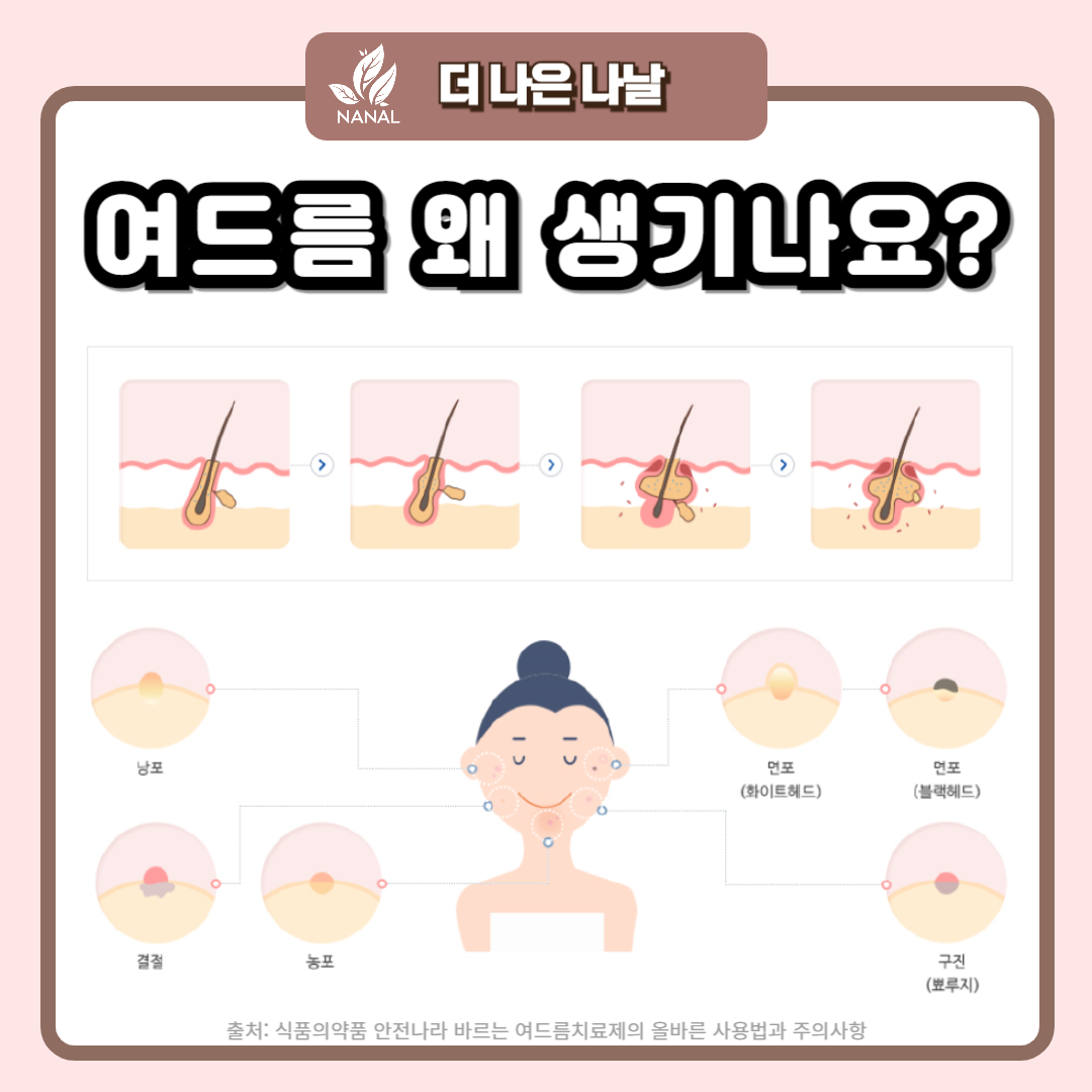 여드름 생기는 이유