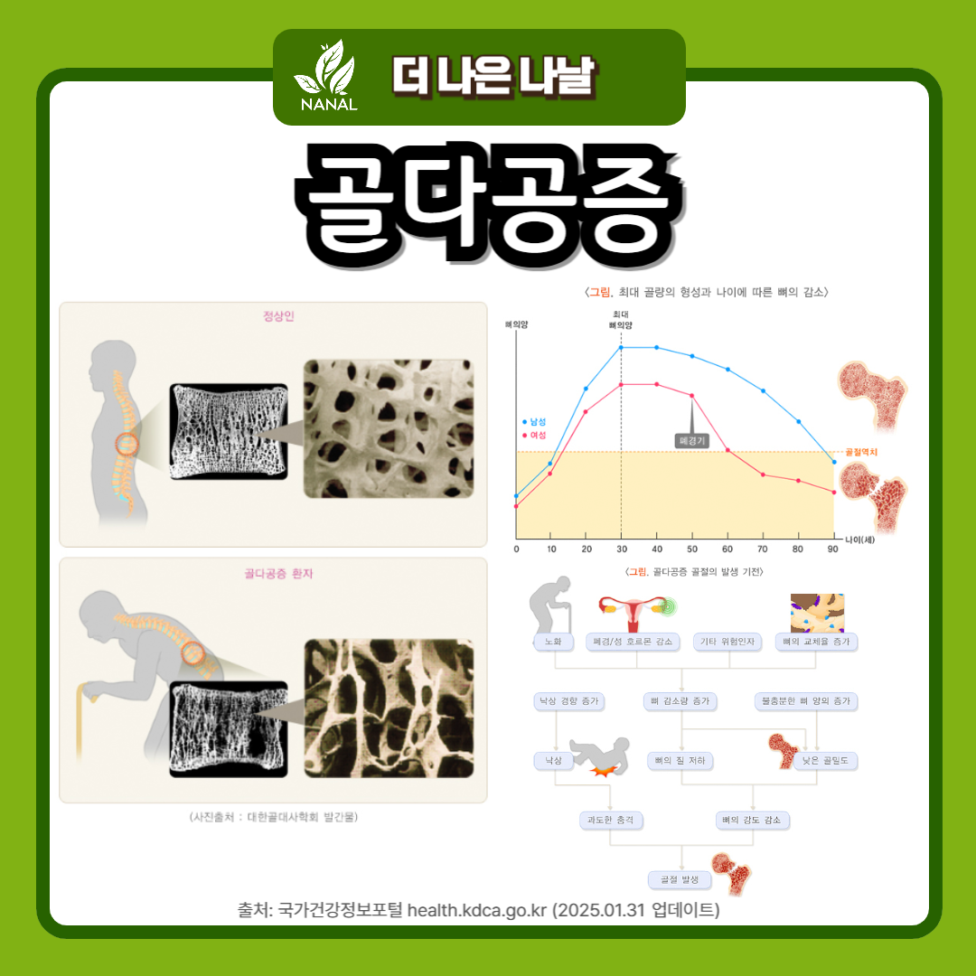 골다공증